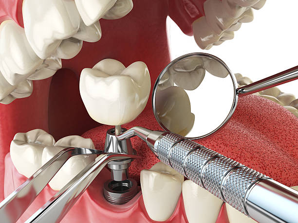 Best Emergency Tooth Extraction in Lake Tapps, WA